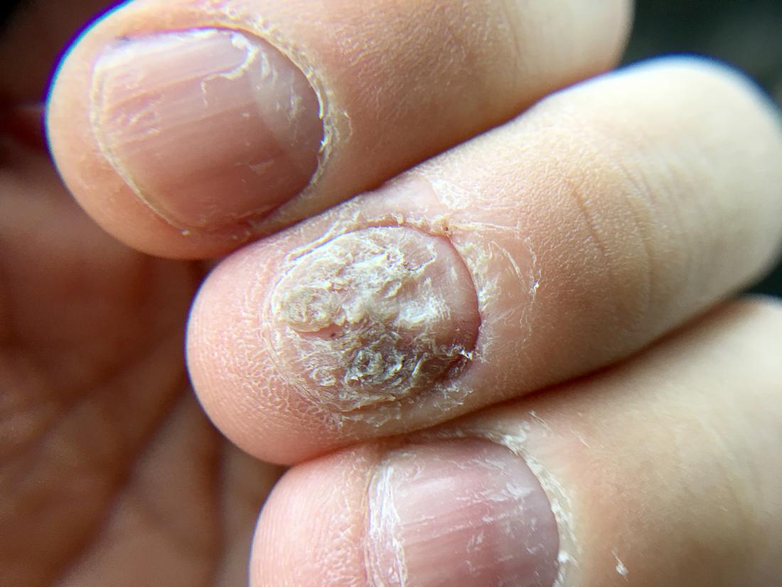 nail-fungus